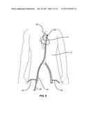 MULTI-ACCESS INTRAPROCEDURAL EMBOLIC PROTECTION DEVICE diagram and image