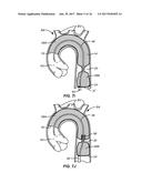 MULTI-ACCESS INTRAPROCEDURAL EMBOLIC PROTECTION DEVICE diagram and image