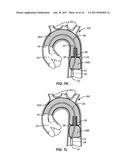 MULTI-ACCESS INTRAPROCEDURAL EMBOLIC PROTECTION DEVICE diagram and image