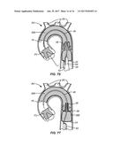 MULTI-ACCESS INTRAPROCEDURAL EMBOLIC PROTECTION DEVICE diagram and image