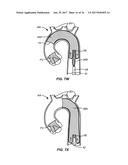 MULTI-ACCESS INTRAPROCEDURAL EMBOLIC PROTECTION DEVICE diagram and image