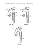 MULTI-ACCESS INTRAPROCEDURAL EMBOLIC PROTECTION DEVICE diagram and image