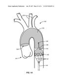 MULTI-ACCESS INTRAPROCEDURAL EMBOLIC PROTECTION DEVICE diagram and image