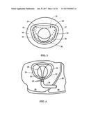 Device and Method for Temporary or Permanent Suspension of an Implantable     Scaffolding Containing an Orifice for Placement of a Prosthetic or     Bio-Prosthetic Valve diagram and image