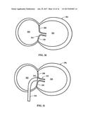 Device and Method for Temporary or Permanent Suspension of an Implantable     Scaffolding Containing an Orifice for Placement of a Prosthetic or     Bio-Prosthetic Valve diagram and image