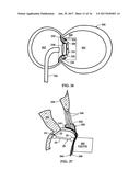 Device and Method for Temporary or Permanent Suspension of an Implantable     Scaffolding Containing an Orifice for Placement of a Prosthetic or     Bio-Prosthetic Valve diagram and image