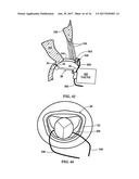 Device and Method for Temporary or Permanent Suspension of an Implantable     Scaffolding Containing an Orifice for Placement of a Prosthetic or     Bio-Prosthetic Valve diagram and image