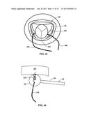 Device and Method for Temporary or Permanent Suspension of an Implantable     Scaffolding Containing an Orifice for Placement of a Prosthetic or     Bio-Prosthetic Valve diagram and image