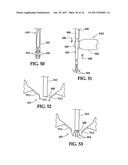 Device and Method for Temporary or Permanent Suspension of an Implantable     Scaffolding Containing an Orifice for Placement of a Prosthetic or     Bio-Prosthetic Valve diagram and image