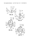 Device and Method for Temporary or Permanent Suspension of an Implantable     Scaffolding Containing an Orifice for Placement of a Prosthetic or     Bio-Prosthetic Valve diagram and image