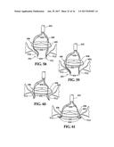 Device and Method for Temporary or Permanent Suspension of an Implantable     Scaffolding Containing an Orifice for Placement of a Prosthetic or     Bio-Prosthetic Valve diagram and image