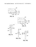 Device and Method for Temporary or Permanent Suspension of an Implantable     Scaffolding Containing an Orifice for Placement of a Prosthetic or     Bio-Prosthetic Valve diagram and image