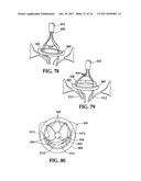 Device and Method for Temporary or Permanent Suspension of an Implantable     Scaffolding Containing an Orifice for Placement of a Prosthetic or     Bio-Prosthetic Valve diagram and image