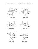 Device and Method for Temporary or Permanent Suspension of an Implantable     Scaffolding Containing an Orifice for Placement of a Prosthetic or     Bio-Prosthetic Valve diagram and image