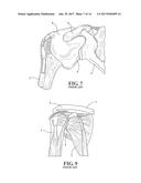 MULTI-COMPONENT IMPLANT ASSEMBLY WITH DUAL ARTICULATING AND/OR ROTATING     SURFACES diagram and image