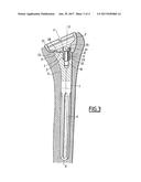 MODULAR HUMERAL PROSTHESIS FOR AN INVERTED SHOULDER PROSTHESIS diagram and image