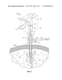 INTERNALLY PRESSURIZED MEDICAL DEVICES diagram and image