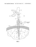 INTERNALLY PRESSURIZED MEDICAL DEVICES diagram and image