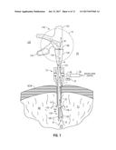 INTERNALLY PRESSURIZED MEDICAL DEVICES diagram and image