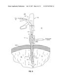 INTERNALLY PRESSURIZED MEDICAL DEVICES diagram and image