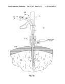 INTERNALLY PRESSURIZED MEDICAL DEVICES diagram and image