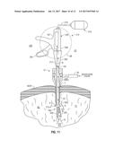 INTERNALLY PRESSURIZED MEDICAL DEVICES diagram and image