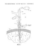 INTERNALLY PRESSURIZED MEDICAL DEVICES diagram and image