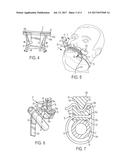 Endotracheal Tube and Nasogastric Tube Attachment Device diagram and image