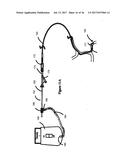 SYSTEMS AND METHODS FOR CONTROLLING REPERFUSION IN A VESSEL diagram and image