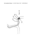 SYSTEMS AND METHODS FOR CONTROLLING REPERFUSION IN A VESSEL diagram and image