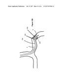 SYSTEMS AND METHODS FOR CONTROLLING REPERFUSION IN A VESSEL diagram and image