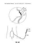 SYSTEMS AND METHODS FOR CONTROLLING REPERFUSION IN A VESSEL diagram and image