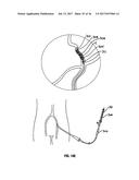 SYSTEMS AND METHODS FOR CONTROLLING REPERFUSION IN A VESSEL diagram and image