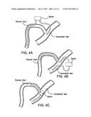 DEVICES AND METHODS FOR ALLEVIATING LYMPHATIC SYSTEM CONGESTION diagram and image