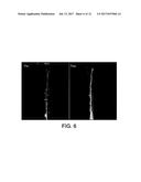 DEVICES AND METHODS FOR ALLEVIATING LYMPHATIC SYSTEM CONGESTION diagram and image