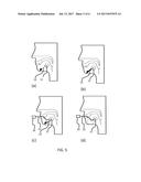 A TONGUE TREATMENT ELECTRODE AND A DEVICE USING THE SAME diagram and image