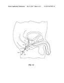 INTRACAVITY BALLOON CATHETER diagram and image