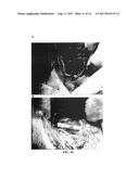 JOINING AND/OR SEALING TISSUES THROUGH PHOTO-ACTIVATED CROSS-LINKING OF     MATRIX PROTEINS diagram and image