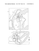 PULMONARY-VEIN CORK DEVICE WITH ABLATION GUIDING TRENCH diagram and image