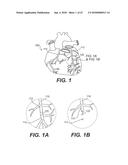 ENDOVASCULAR DEVICES AND METHODS FOR EXPLOITING INTRAMURAL SPACE diagram and image