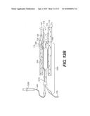 ENDOVASCULAR DEVICES AND METHODS FOR EXPLOITING INTRAMURAL SPACE diagram and image