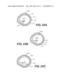 ENDOVASCULAR DEVICES AND METHODS FOR EXPLOITING INTRAMURAL SPACE diagram and image