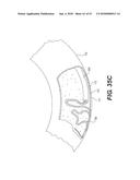 ENDOVASCULAR DEVICES AND METHODS FOR EXPLOITING INTRAMURAL SPACE diagram and image