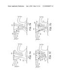 AORTIC ARCH FILTRATION CATHETER FOR CAROTID ARTERY PROTECTION AND METHODS     OF USE diagram and image