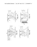 AORTIC ARCH FILTRATION CATHETER FOR CAROTID ARTERY PROTECTION AND METHODS     OF USE diagram and image