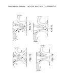 AORTIC ARCH FILTRATION CATHETER FOR CAROTID ARTERY PROTECTION AND METHODS     OF USE diagram and image