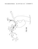 AORTIC ARCH FILTRATION CATHETER FOR CAROTID ARTERY PROTECTION AND METHODS     OF USE diagram and image