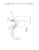 AORTIC ARCH FILTRATION CATHETER FOR CAROTID ARTERY PROTECTION AND METHODS     OF USE diagram and image