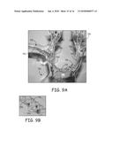 AORTIC ARCH FILTRATION CATHETER FOR CAROTID ARTERY PROTECTION AND METHODS     OF USE diagram and image