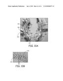 AORTIC ARCH FILTRATION CATHETER FOR CAROTID ARTERY PROTECTION AND METHODS     OF USE diagram and image